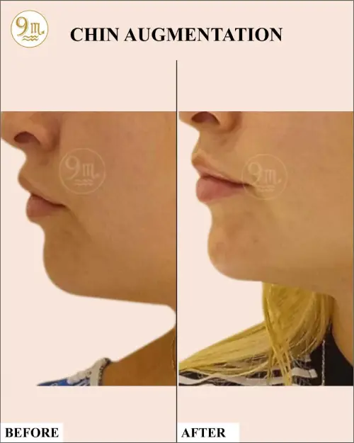 chin-aug3