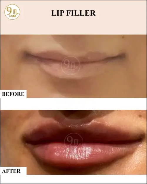 lip_f2