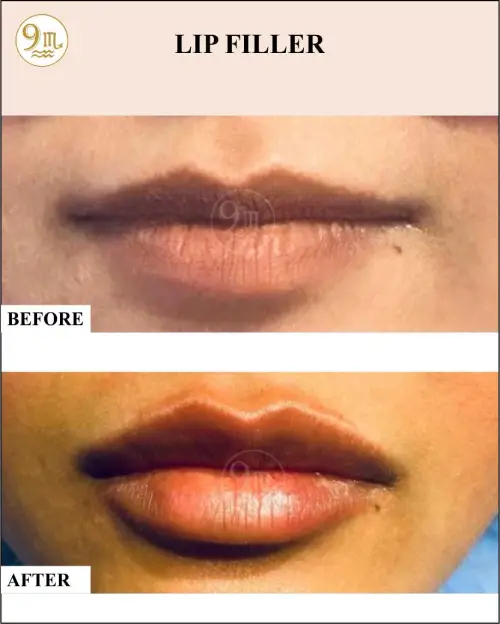 lip_f5