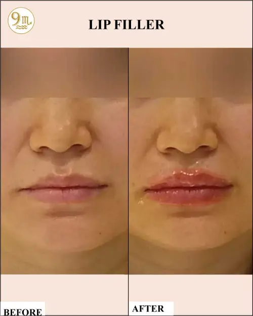 lip_f6
