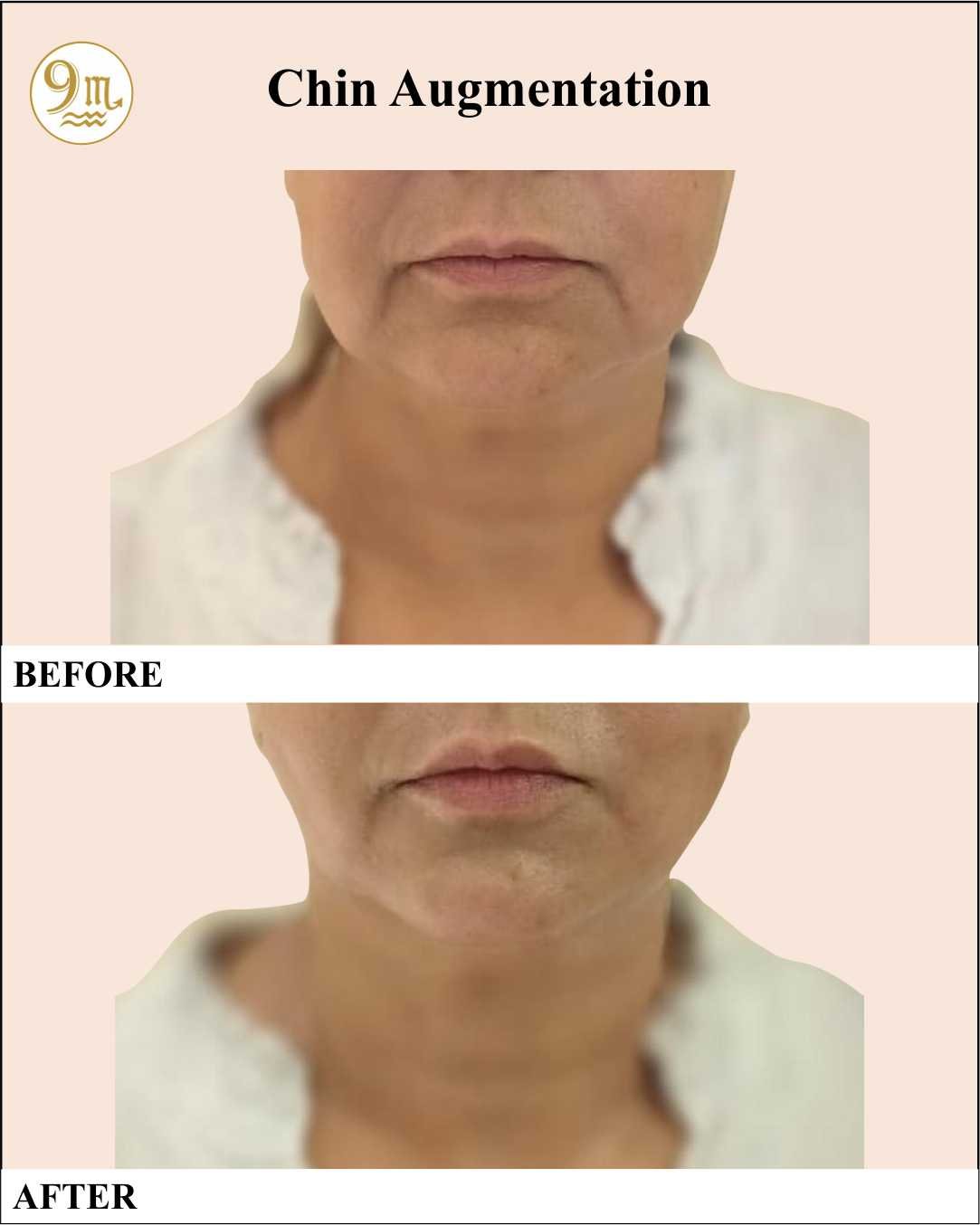 9M Clinic_10_Chin Augmentation