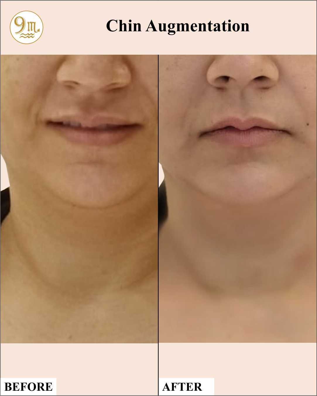 9M Clinic_11_Chin Augmentation