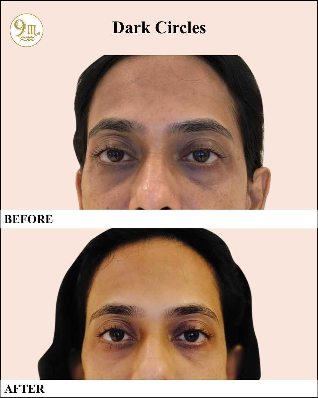 9M Clinic_2_DarkCircles