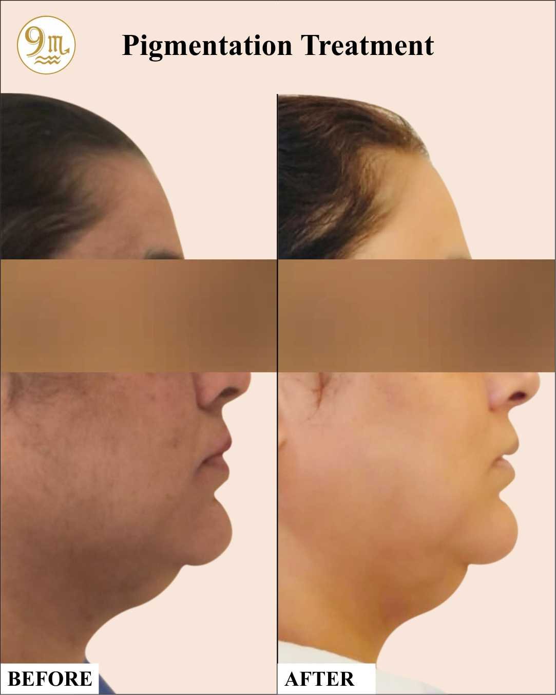 9M Clinic_3_Pigmentation Treatment