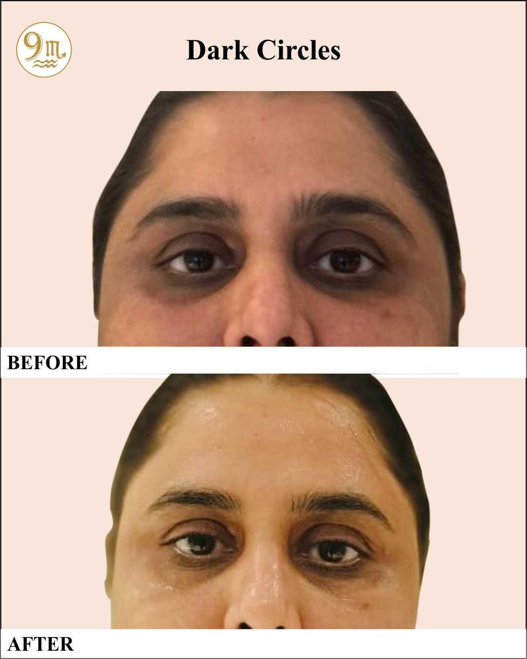 9M Clinic_4_Dark_Circles_BEFOREAFTER1