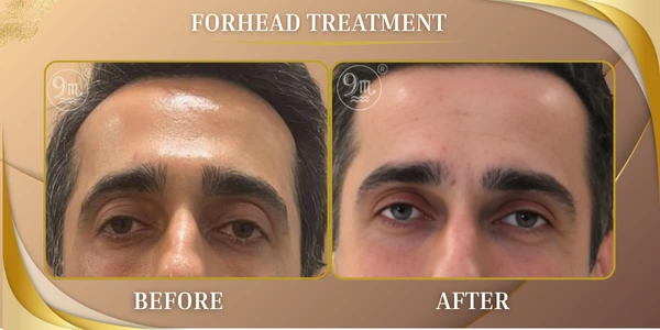 Forhead treatment