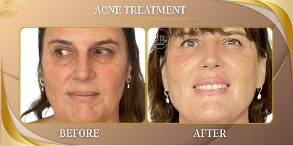 Acne Treatment