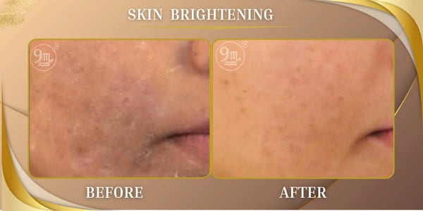 Skin Brightening