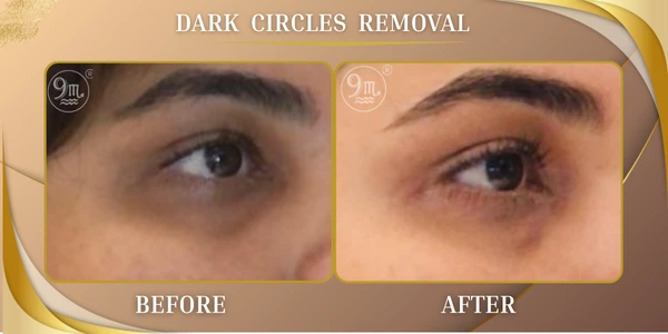 Dark Circles Removal