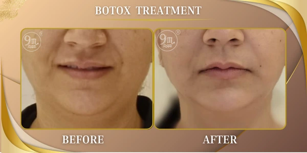 Botox Treatment