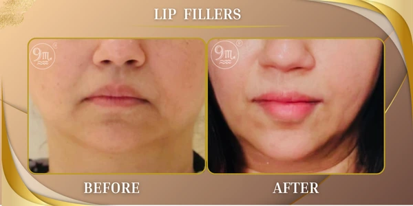 Lip Fillers