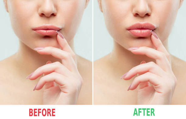 Lip-Fillers