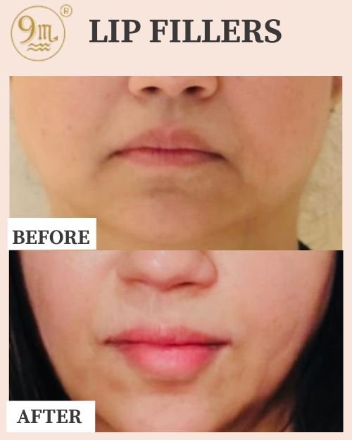 LIP FILLERS (1)