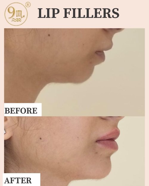 LIP FILLERS