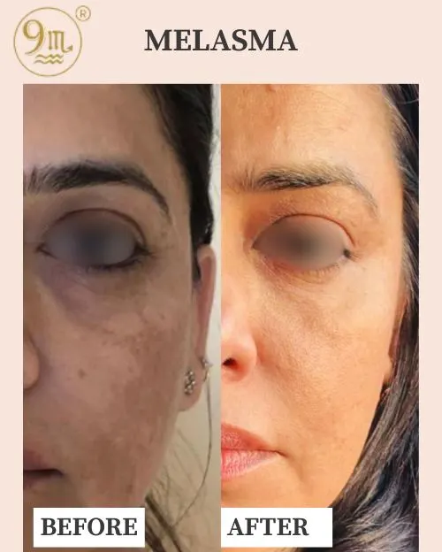 MELASMA