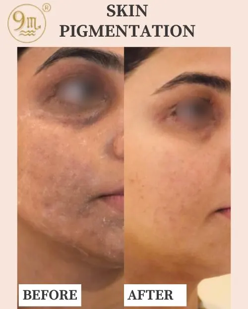 SKIN-PIGMENTATION