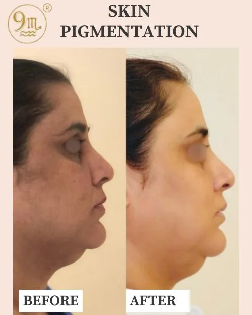 SKIN-PIGMENTATION