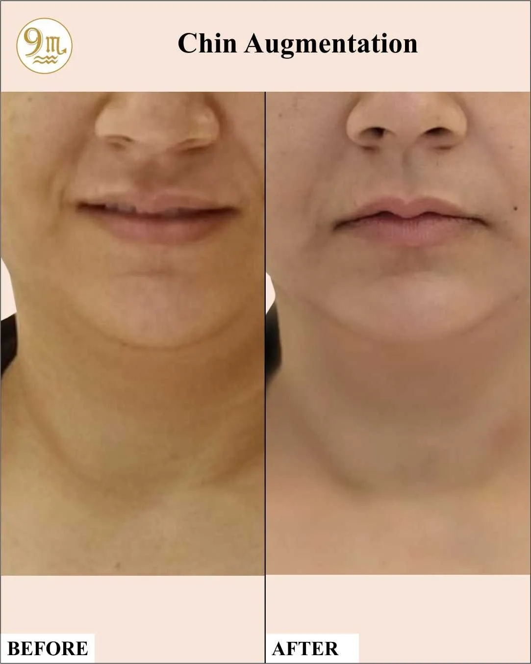 imgi_14_9M-Clinic_11_Chin-Augmentation