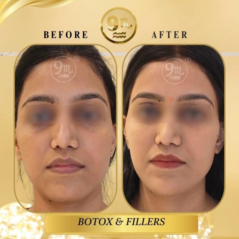 BOTOX & FILLERS TREATMENT (7)