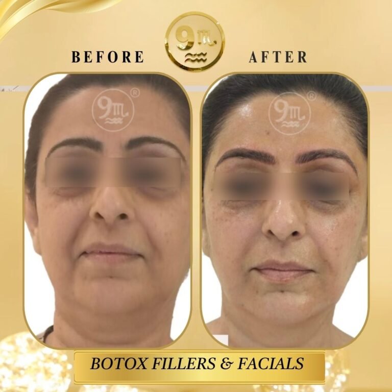 BOTOX & FILLERS TREATMENT (2)