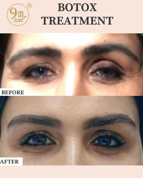 BOTOX & FILLERS TREATMENT