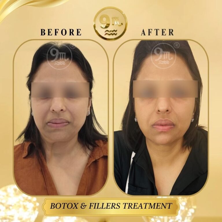 BOTOX & FILLERS TREATMENT (5)