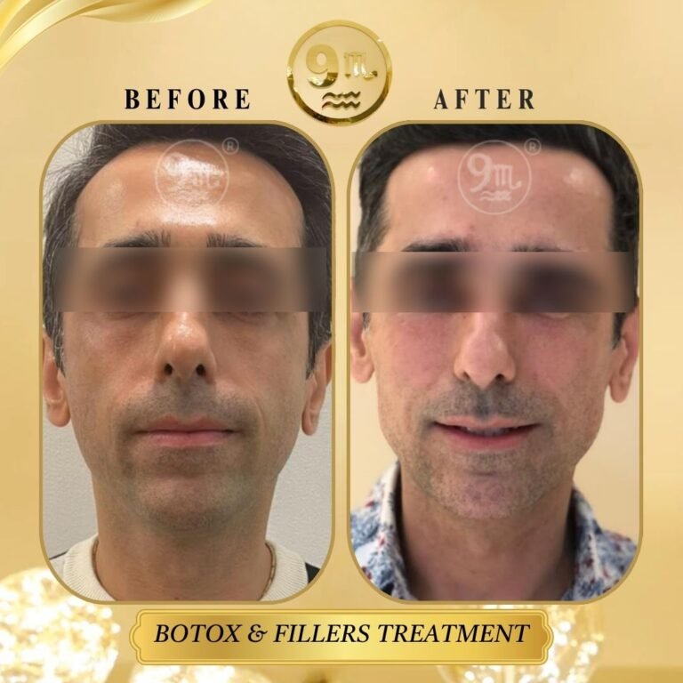 BOTOX & FILLERS TREATMENT (6)