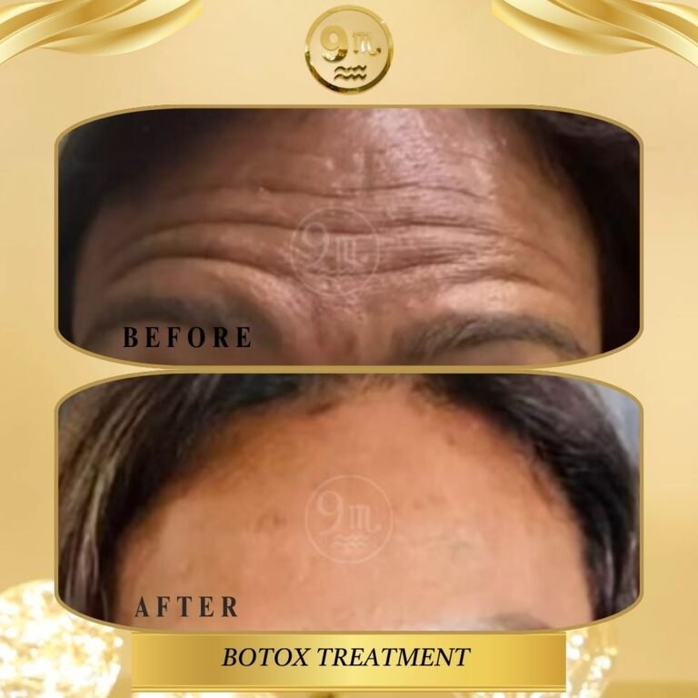 BOTOX & FILLERS TREATMENT (7)