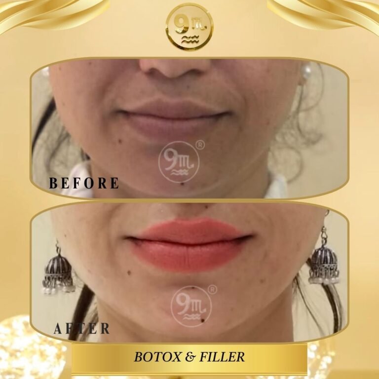 BOTOX & FILLERS TREATMENT (8)