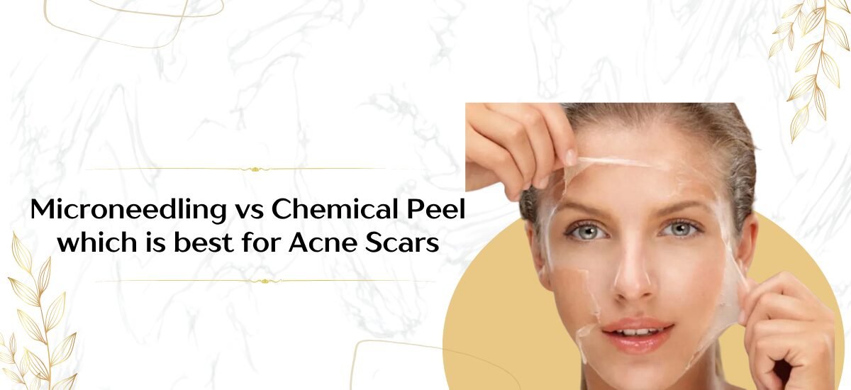 Microneedling vs Chemical which is best Peel for Acne Scars?