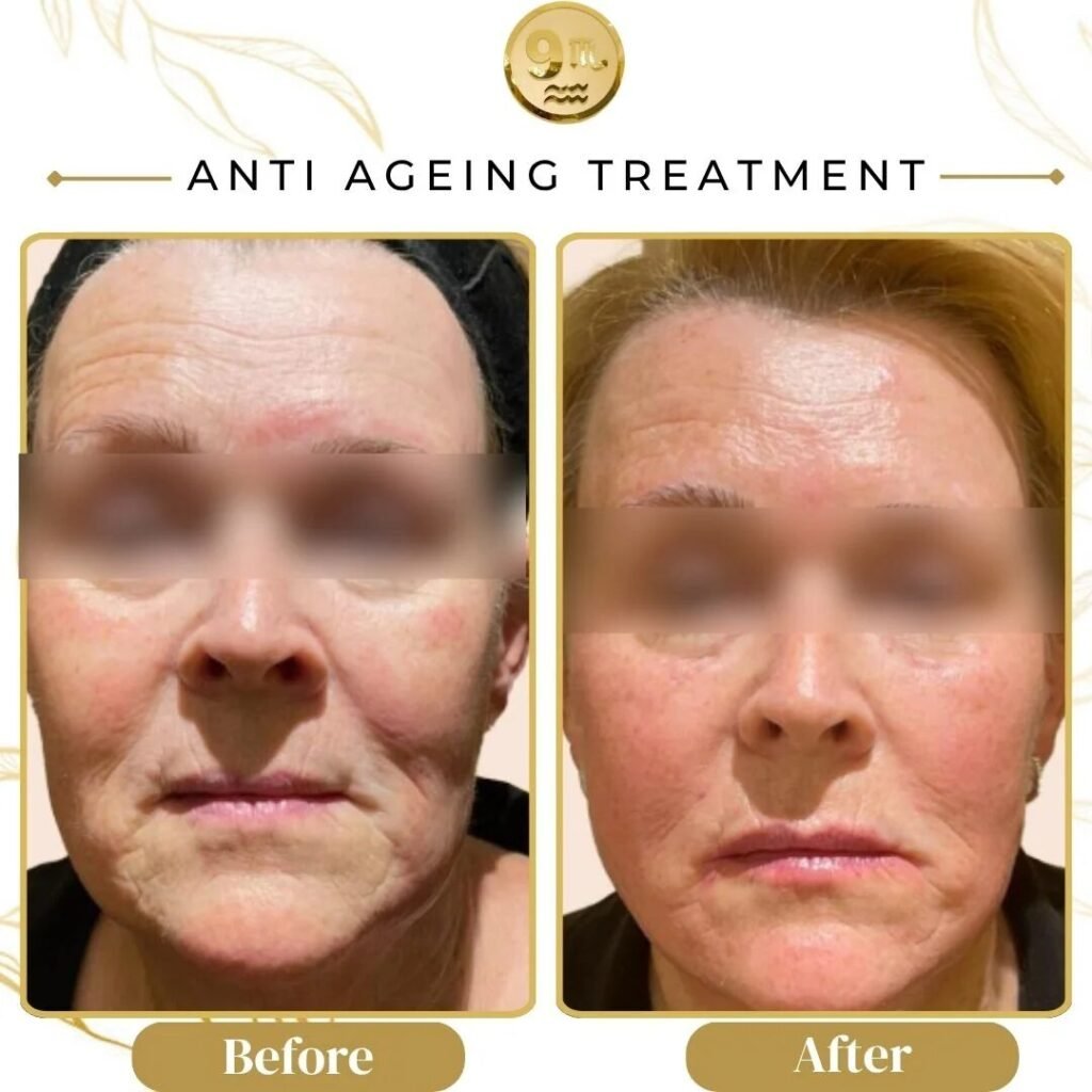 Before and after comparison of a facial anti-aging treatment showing smoother skin and fewer wrinkles around the mouth and cheeks.