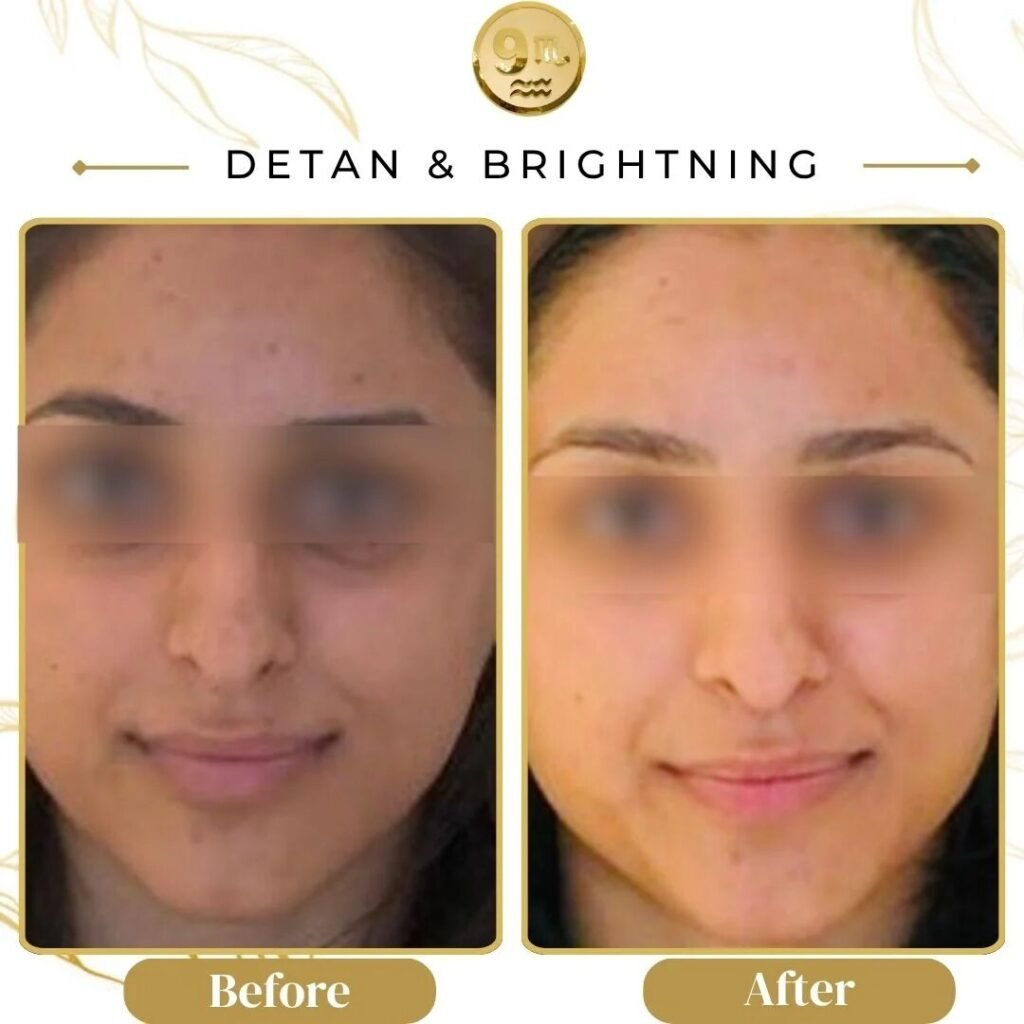 Before and after comparison of a woman's face after cosmetic treatment; left image shows current skin before, right shows improved skin; eyes blurred for privacy; captions 'Before' and 'After' at the bottom.