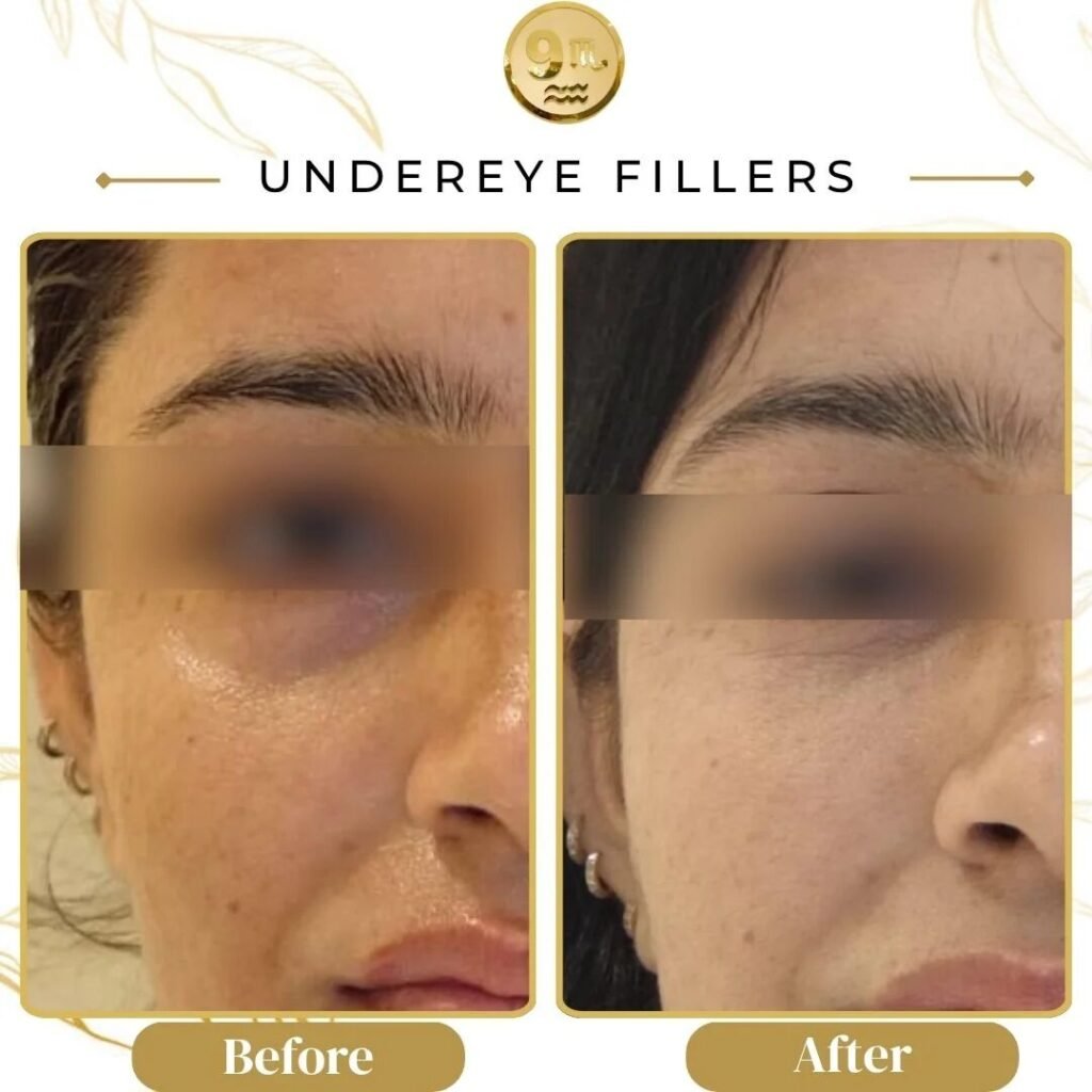Before-and-after collage of under-eye filler treatment: left shows puffiness and dark circles, right shows smoother under-eye area.