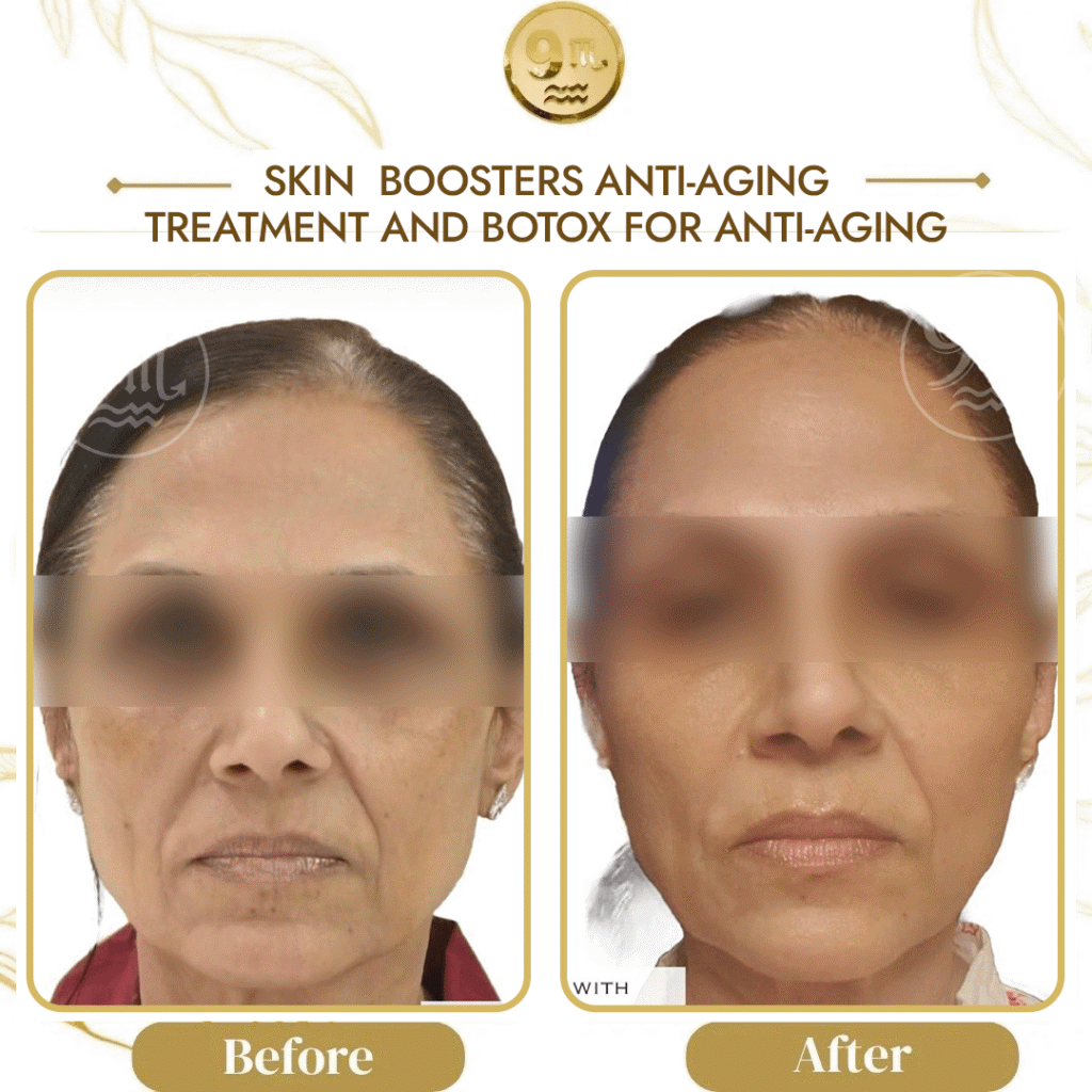 Side-by-side before and after photos of a woman's face from a skin rejuvenation treatment; eyes blurred, labels 'Before' and 'After'.