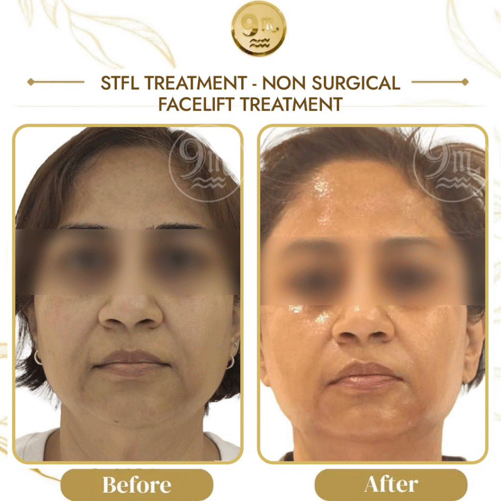 Before-and-after comparison of a woman's face showing non-surgical facelift results, with improved jawline and smoother skin width borders framed.