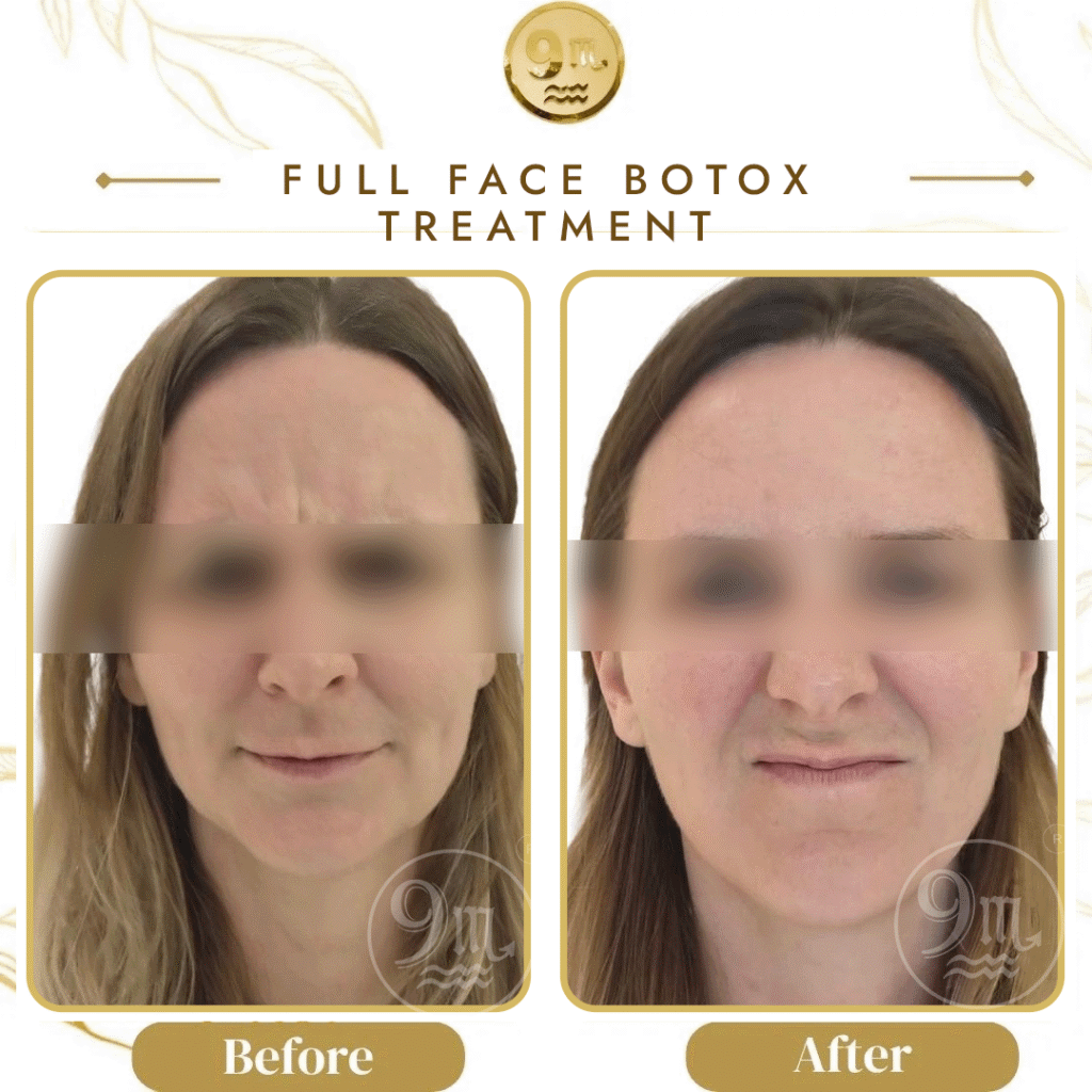 Before and after photos showing full-face Botox treatment, with 'Full Face Botox Treatment' headline and blurred eyes for privacy.