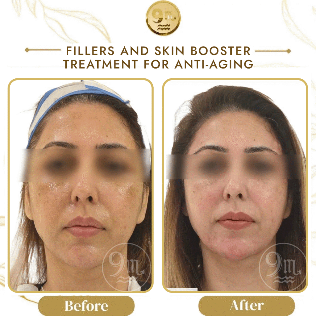 Comparison photo showing a woman's face before and after fillers and skin booster treatment for anti-aging; labels read 'Before' and 'After'