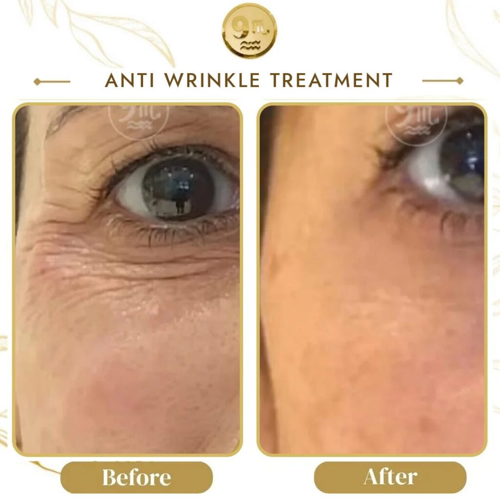 Close-up of an eye area showing before and after anti-wrinkle treatment; left panel has more wrinkles, right panel smoother skin.