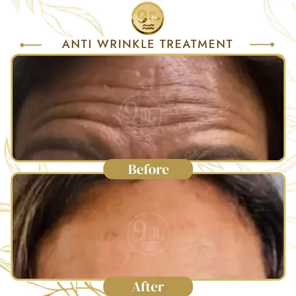 Before-and-after image showing forehead treated with anti-wrinkle treatment: top shows deep wrinkles, bottom shows smoother skin.