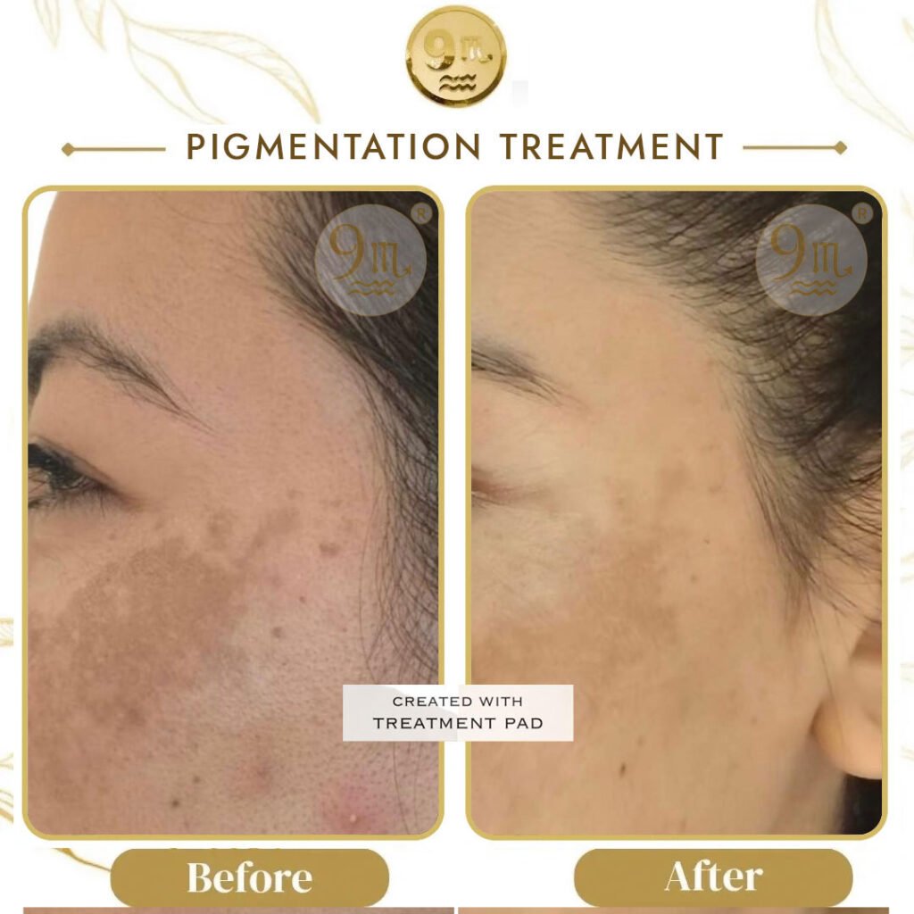 Before and after close-up of facial pigmentation treatment, showing reduced dark spots and more even skin tone (left vs right).