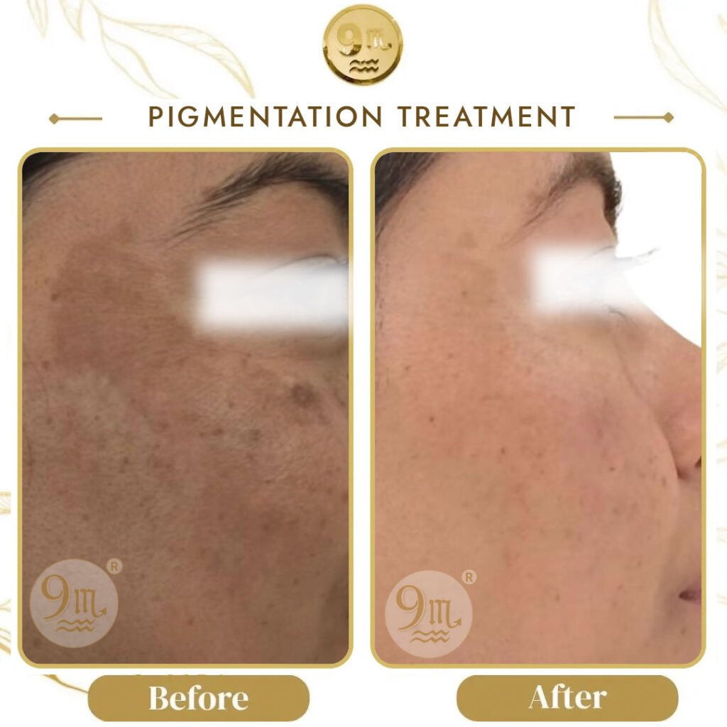 Side-by-side cheek photos labeled Before and After, showing reduced pigmentation and more even skin tone after treatment.