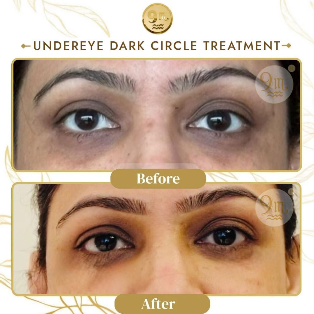 Before-and-after close-up of a woman's eyes showing reduction in under-eye dark circles after treatment.